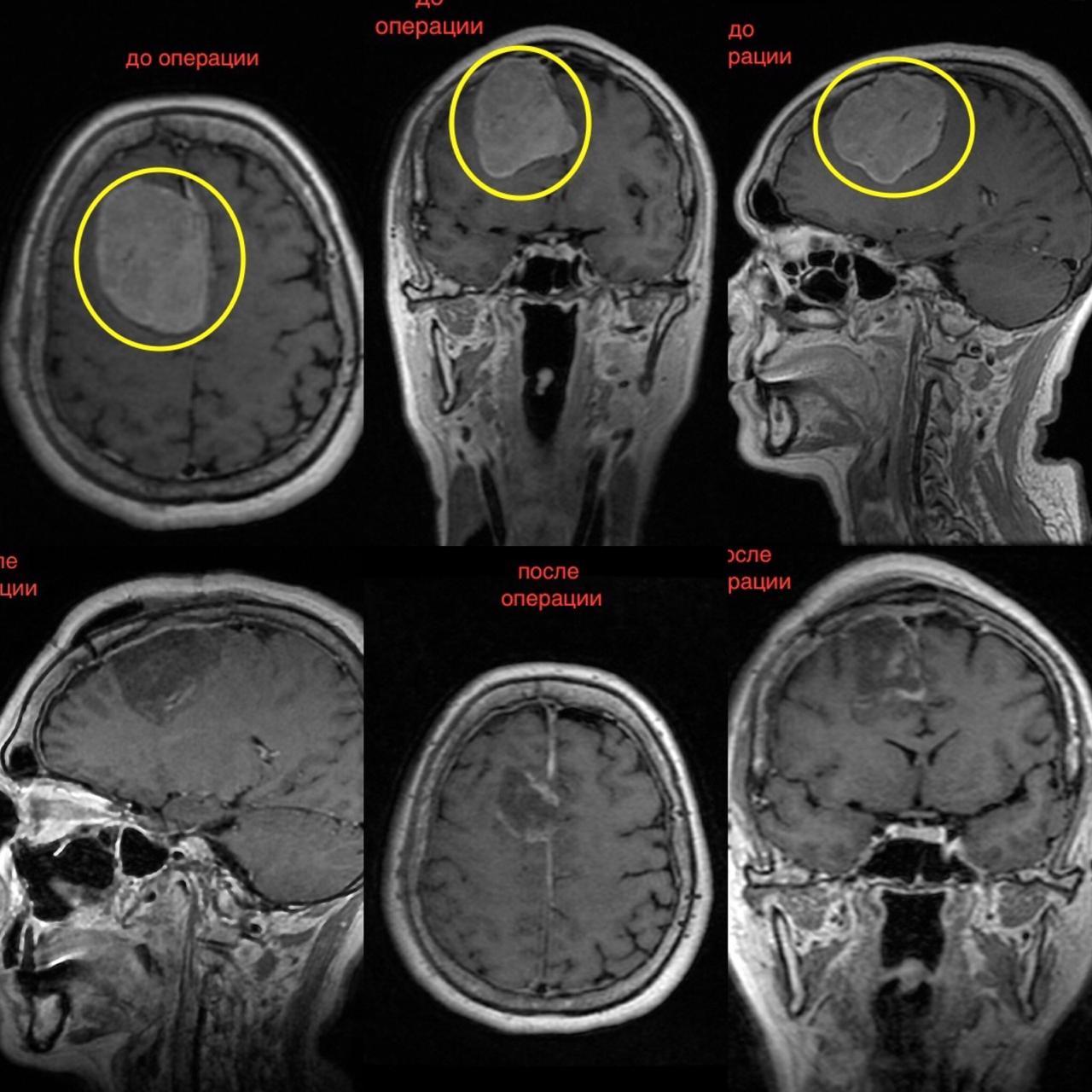 Врачи Одинцовского округа удалили женщине опухоль мозга размером с куриное  яйцо | РИАМО